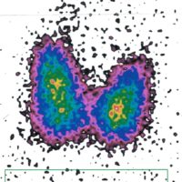 Bild Schilddrüsenszintigramm
